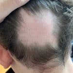 Kreisrunder Haarausfall Hinterkopf