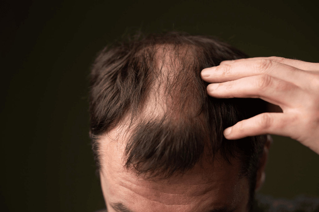 Erblich bedingter Haarausfall bei Mann