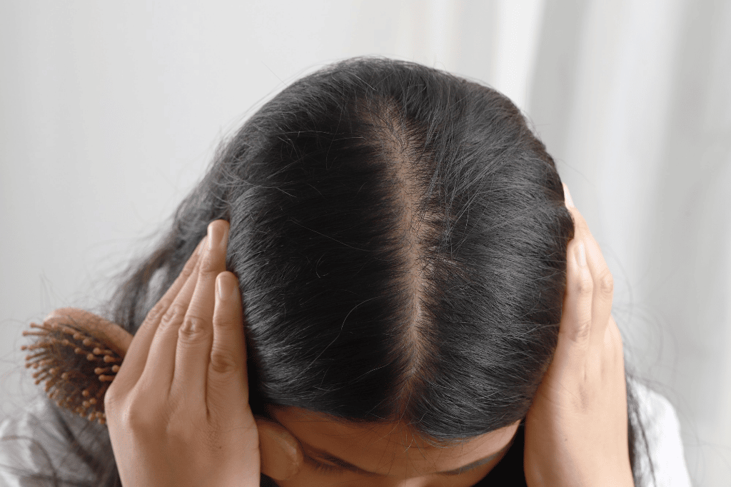 Erblich bedingter Haarausfall bei Frau