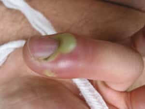 Nagelbettentzündung