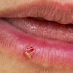 Herpes an der Lippe