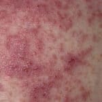 Dermatitis herpetiformis Ausschlag