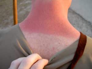Sonnenbrand