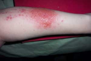 Nässende Kontaktdermatitis am Unterarm mit Blasenbildung.