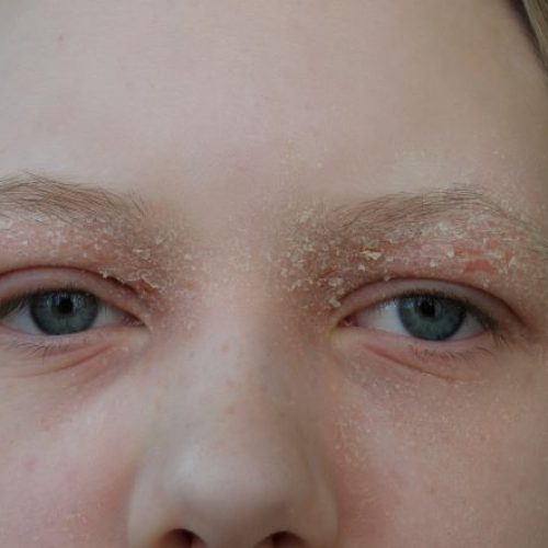 Lidekzem: Symptome, Diagnose & Behandlung direkt vom Online-Hautarzt | doctorderma