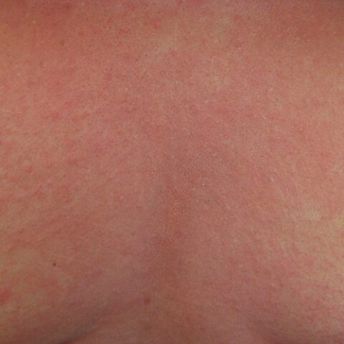 Allergie, Hautausschlag