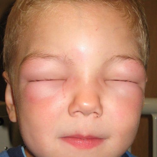 Allergischer Schock, Kind
