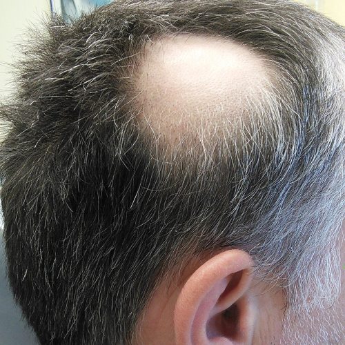 Kreisrunder Haarausfall Diagnose Therapie Direkt Vom Online