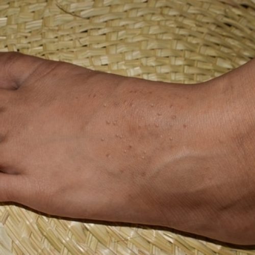Dellwarzen: Behandlung & Diagnose direkt vom Online-Hautarzt | doctorderma