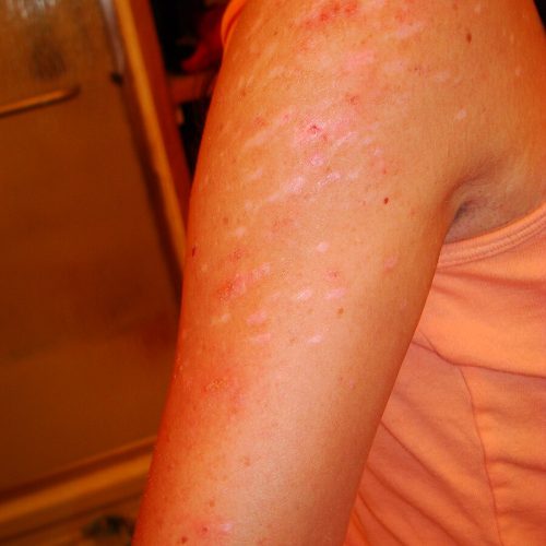 Arm einer Frau mit Skin Picking Disorder