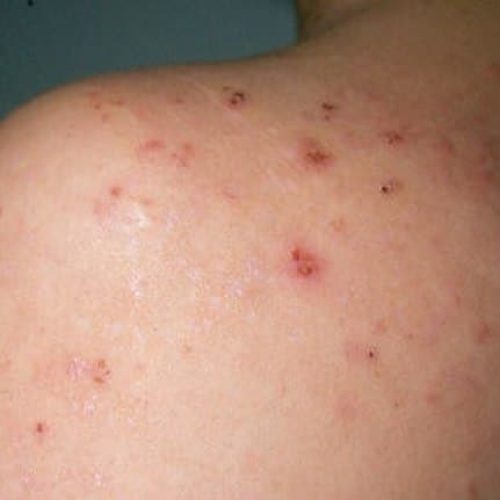 Dermatitis herpetiformis Schulter