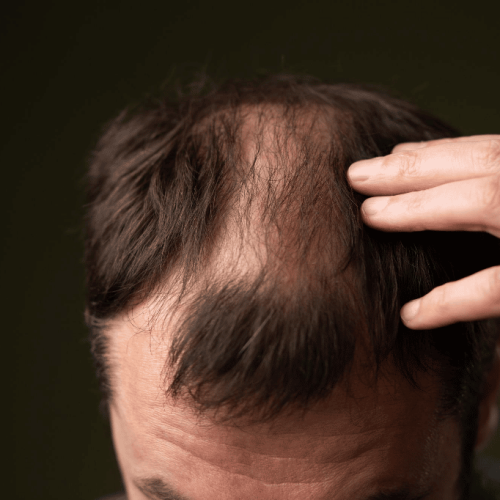 Erblich bedingter Haarausfall bei Mann