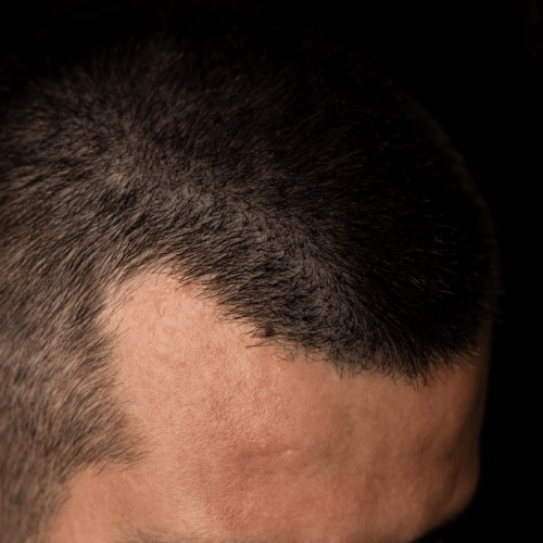 Erblich bedingter Haarausfall mit Geheimratsecken