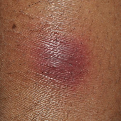 Einzelnes Erythema nodosum