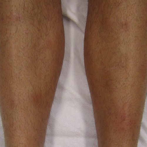 Erythema nodosum Schienbeine