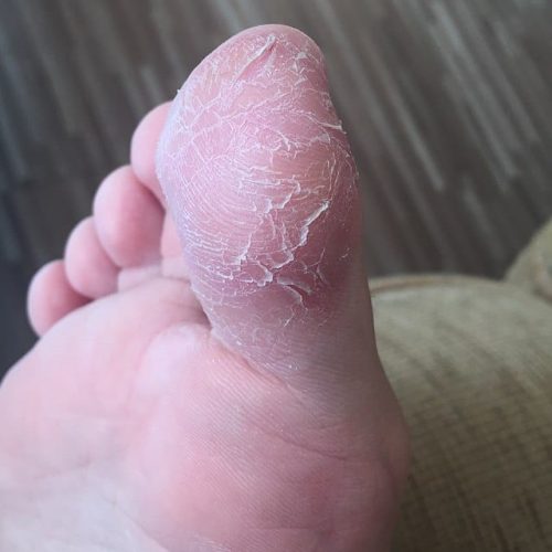 Fußpilz schuppige Haut