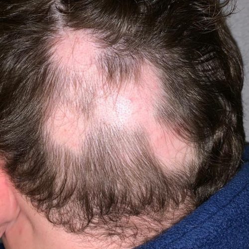 kreisrunder Haarausfall bei einem Mann
