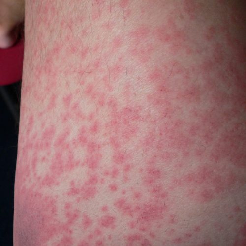 allergischer Hautausschlag am Oberschenkel