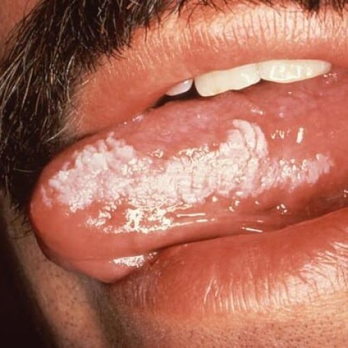 Leukoplakie, Zunge