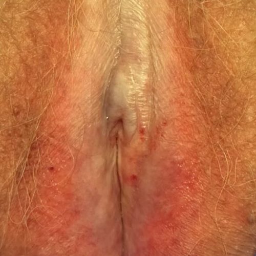 Lichen Sclerosus Vulva