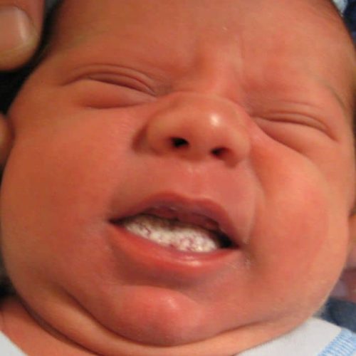 Mundsoor, Baby