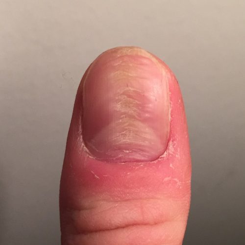 Nagelkrankheit Verformung