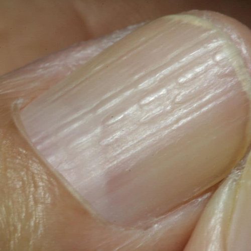 Nagelkrankheit Längsrillen