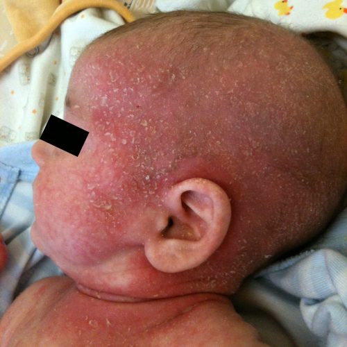 Neurodermitis bei Baby mit Hautausschlag und Schuppenbildung