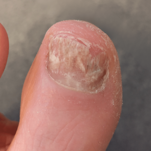 Nagelpilz am Fuß