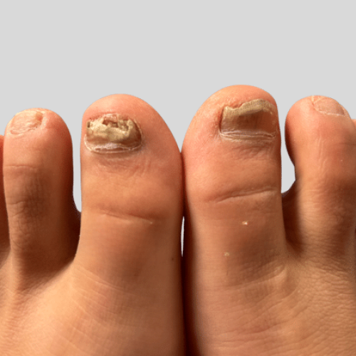 Nagelpilz am Fuß