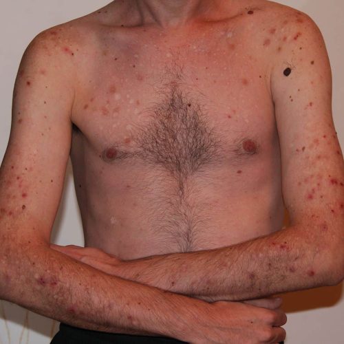 Junger Mann mit Dermatillomanie