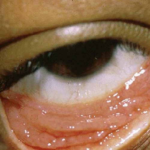 Chlamydia-Infektion Auge