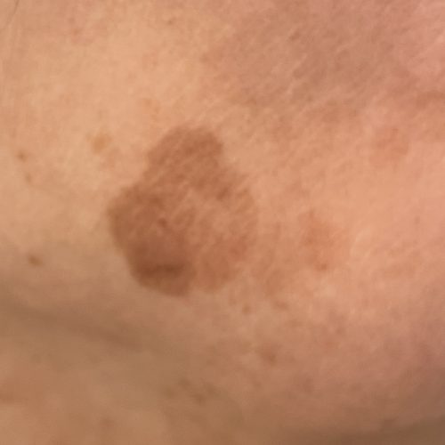 Sonnenflecken Behandlung & Diagnose direkt vom OnlineHautarzt doctorderma