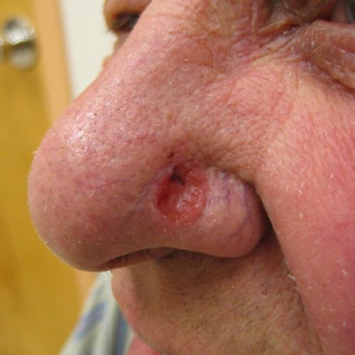 Basalzellkarzinom am linken Nasenflügel eines Mannes