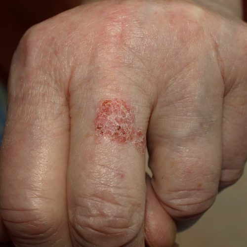 Vorstufe eines Plattenepithelkarzinoms am Fingerrücken