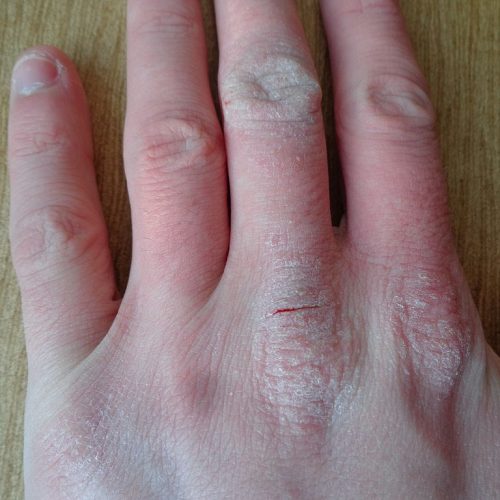 Neurodermitis an der Hand