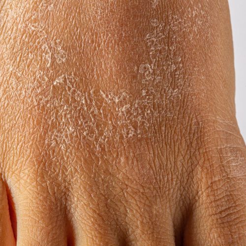 Trockene Haut äußert sich häufig an den Füßen. Häufig kommt es ebenfalls zur Schuppenbildung.
